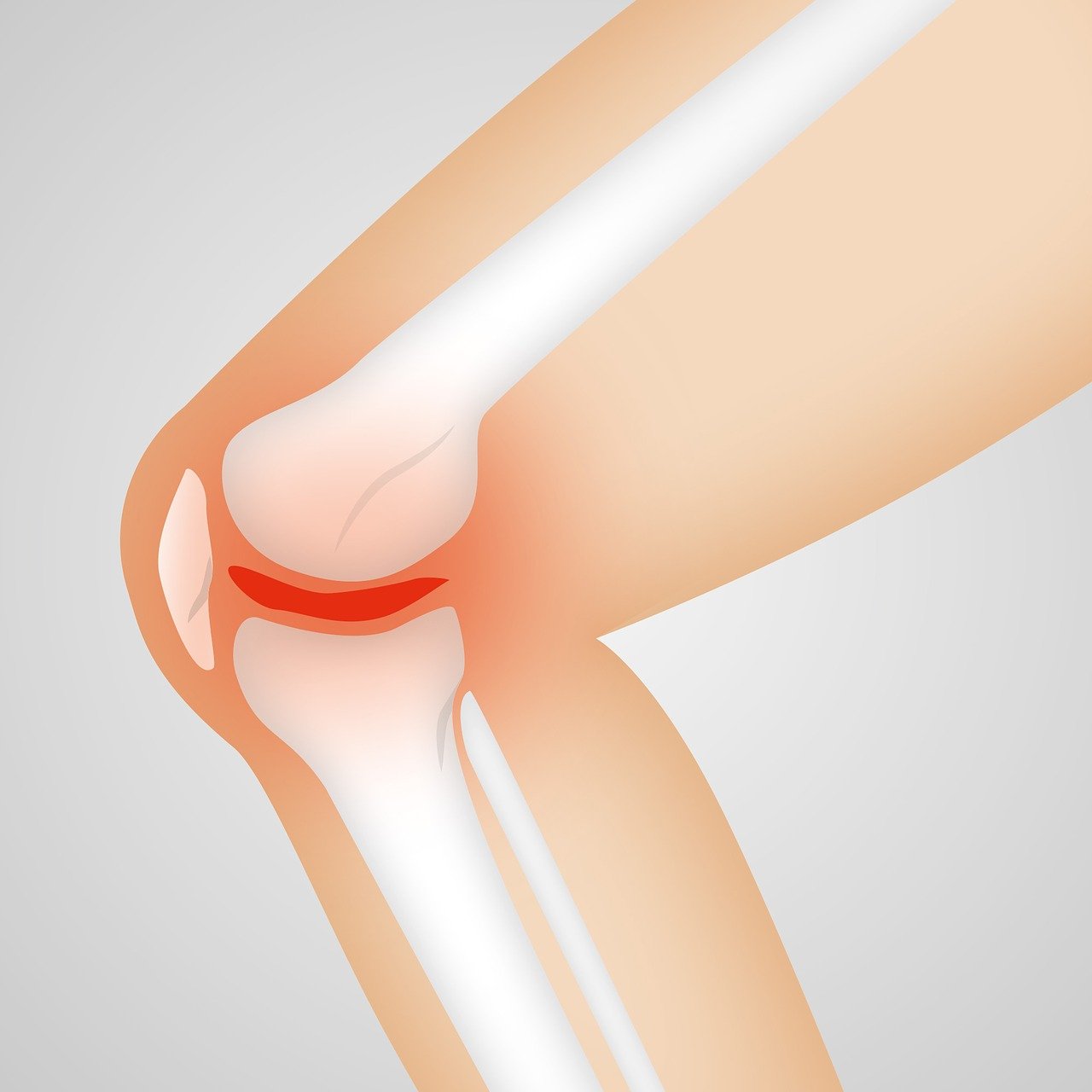 erfahren sie alles wichtige über osteoarthritis: ursachen, symptome und moderne behandlungsmöglichkeiten zur schmerzlinderung und verbesserung der lebensqualität.