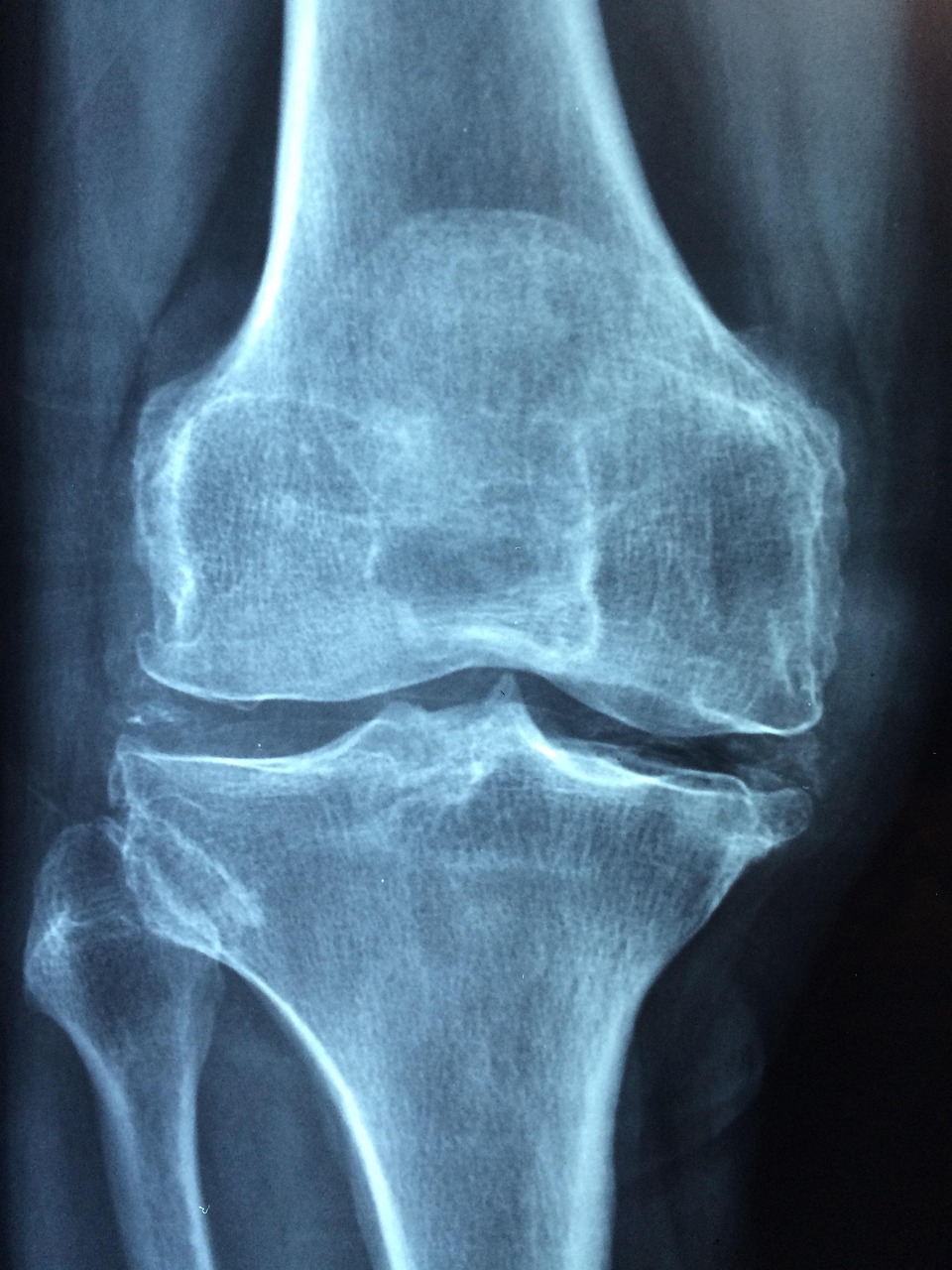 erfahren sie mehr über osteoarthritis, eine häufige gelenkerkrankung, die schmerzen und steifheit verursacht. informieren sie sich über symptome, ursachen und behandlungsmöglichkeiten.